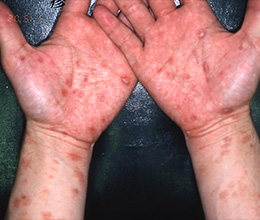 梅毒による皮膚の発疹