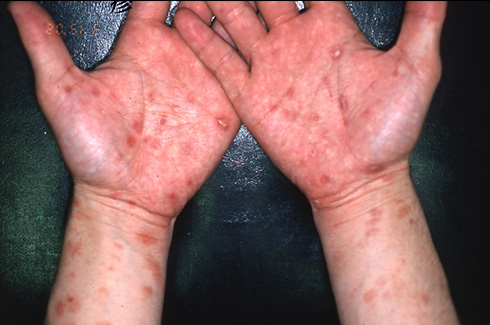 梅毒による皮膚の発疹